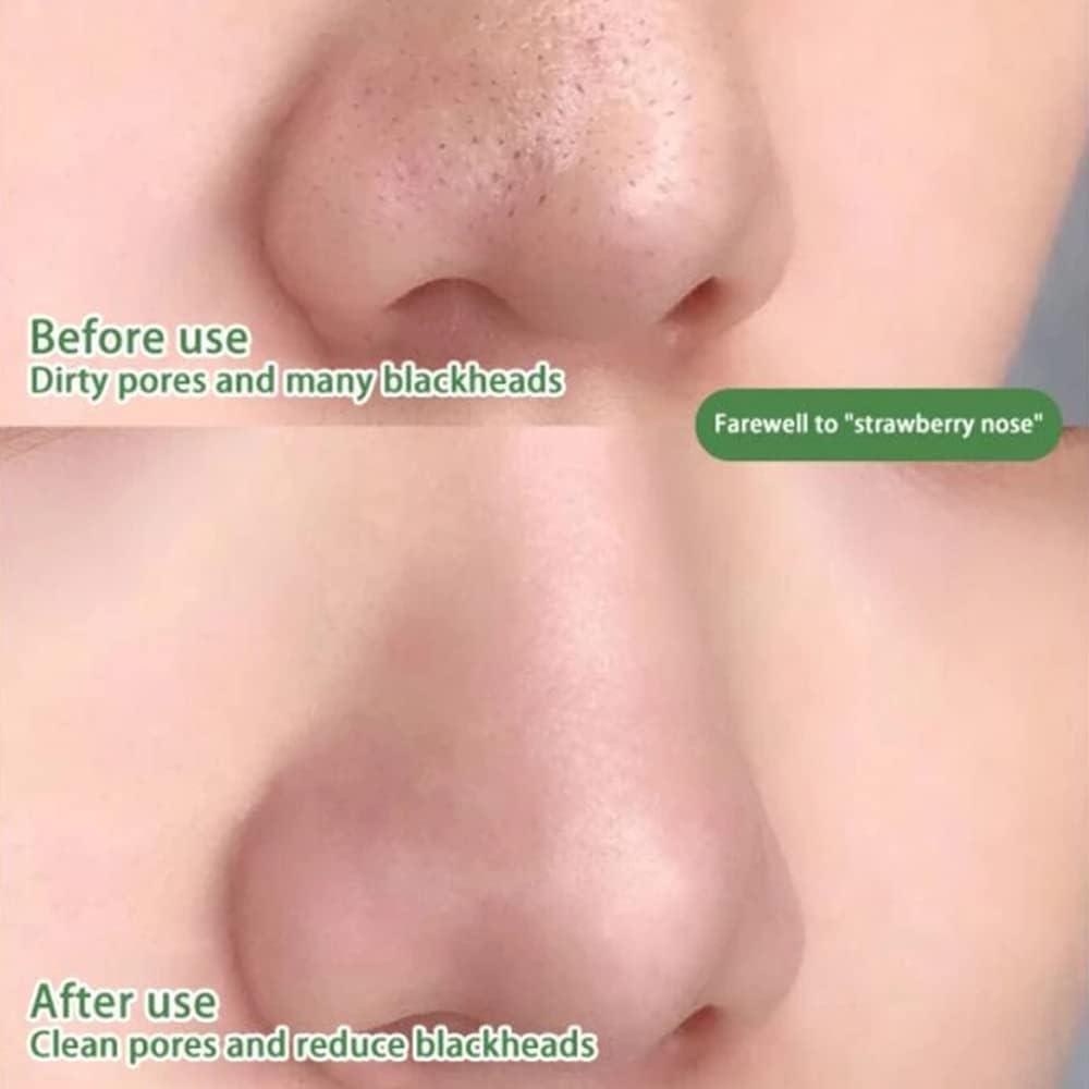 Pórustisztító És Aknékontroll Maszk